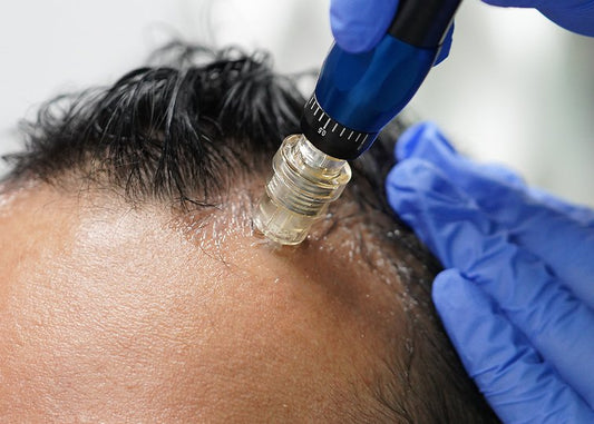 Hairline Revival Starts Here: Microneedling That Wakes Up More Than Just Your Roots