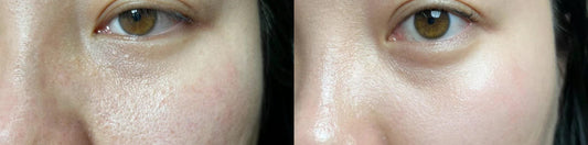 Bye Bumps: Milia Seed Removal That’s Fast, Fuss-Free, and (Dare We Say?) Bready Good